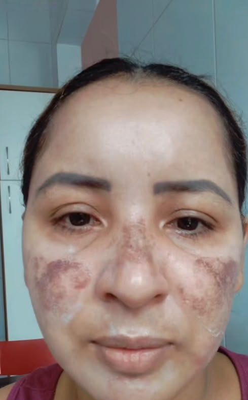 Antes: rosto da paciente com manchas de melasma nas maçãs do rosto e no nariz